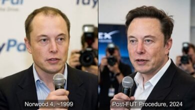Elon Musk Hair Transplant